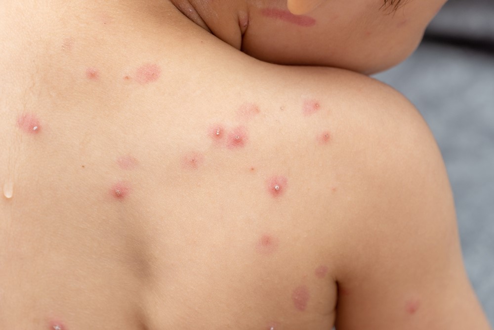 Conheça os sintomas e a prevenção contra a varíola dos macacos